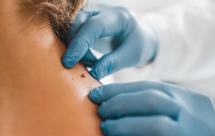 Examen d'un grain de beauté